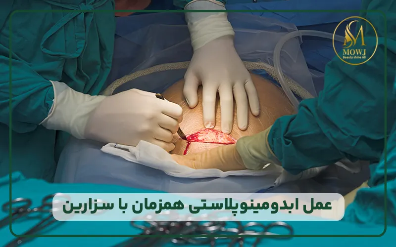 ابدومینوپلاستی همزمان با سزارین
