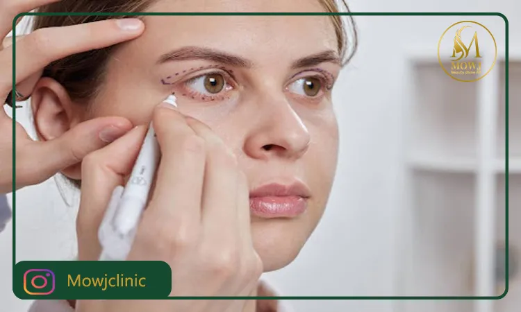 جراحی افتادگی پلک