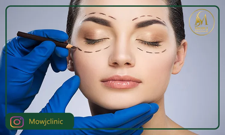 عمل بلفاروپلاستی