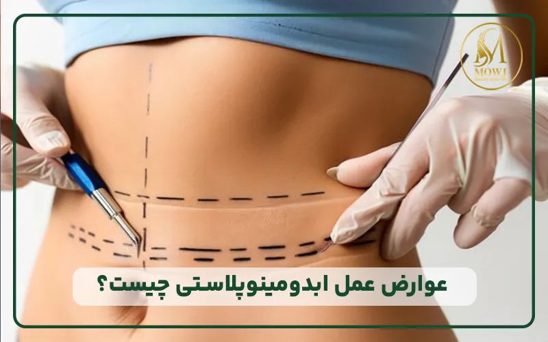 عوارض ابدومینوپلاستی چیست