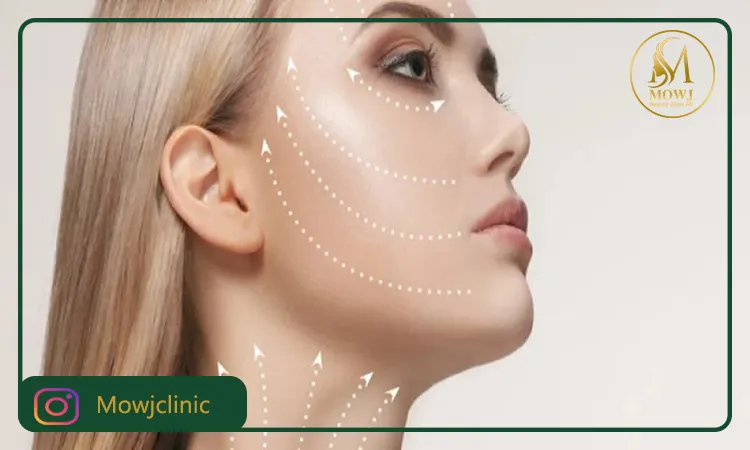 هزینه اندولیفت