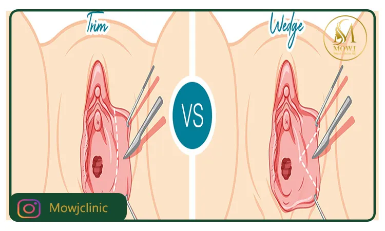 روش انجام لابیاپلاستی