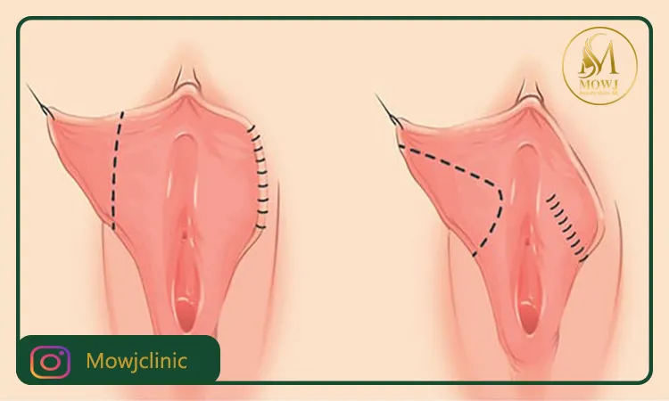 عوارض جراحی لابیاپلاستی
