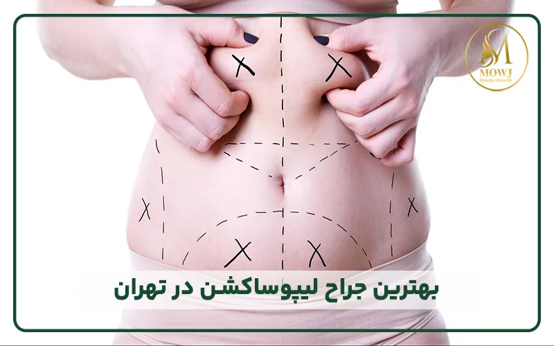 بهترین جراح لیپوساکشن در سعادت آباد