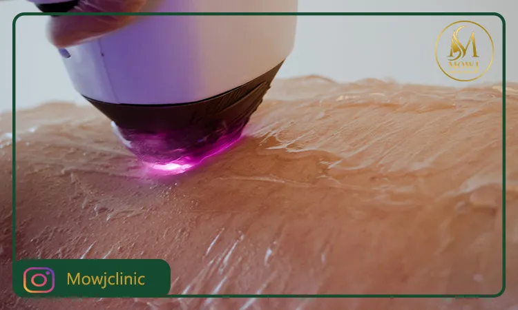 مراقبت های بعد از لیزر ناحیه تناسلی مردان