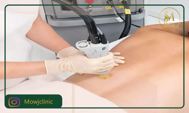 نحوه انجام لیزر ناحیه تناسلی مردان