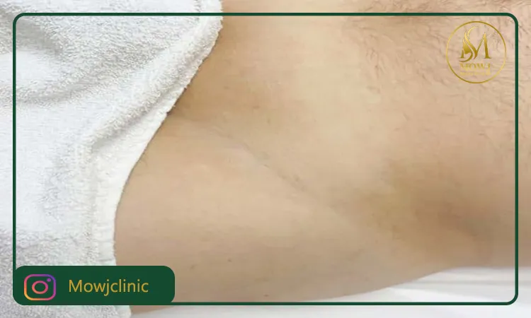 فواید بعد از لیزر ناحیه تناسلی مردان