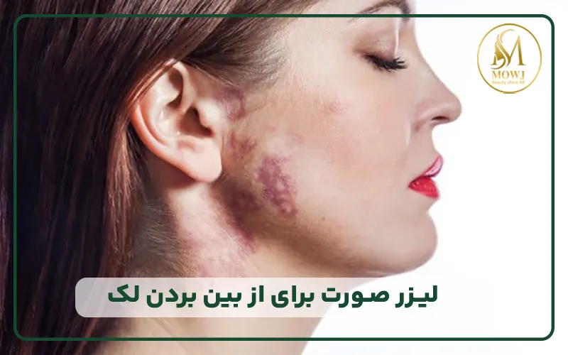 لیزر صورت برای از بین بردن لک