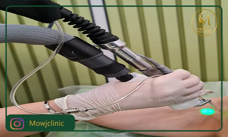 مهم‌ترین شاخصه دستگاه لیزر دکا