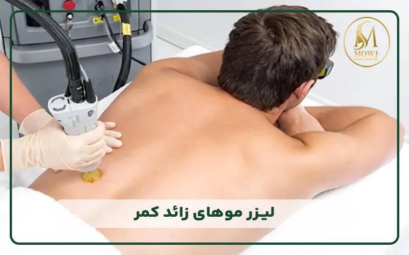 لیزر موهای کمر