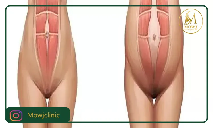 عمل ابدومینوپلاستی همراه با سزارین چه مزایایی دارد؟