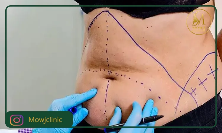 سروما یکی از عوارض آبدومینوپلاستی شکم است.