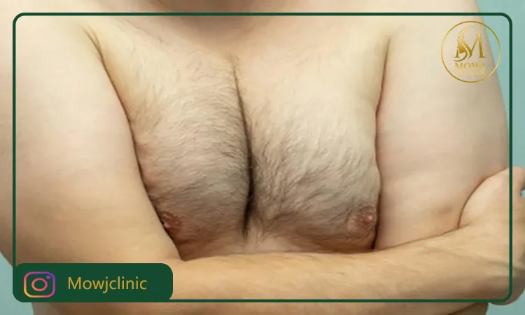 ژنیکوماستی