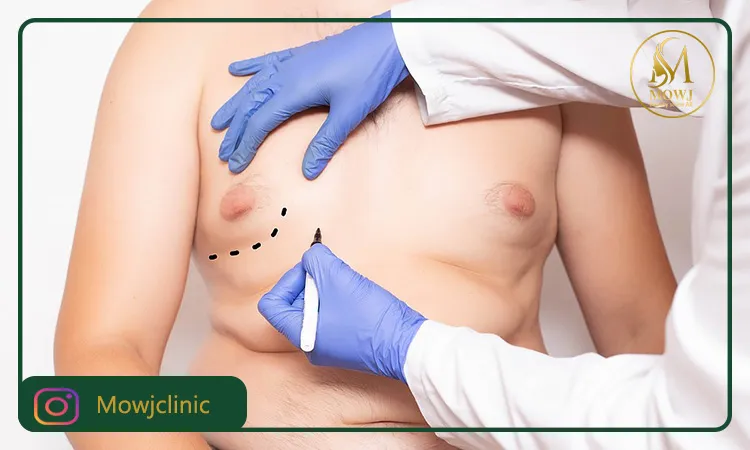 جراحی ژنیکوماستی