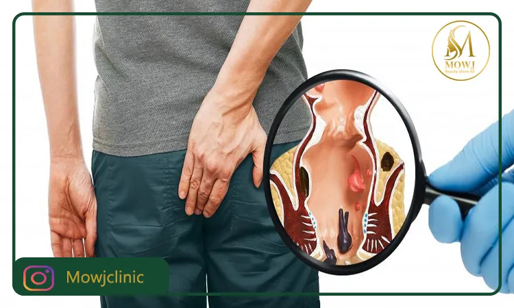 هموروئید چیست؟