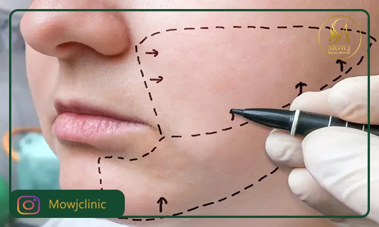 بهترین جراح بوکال فت در تهران