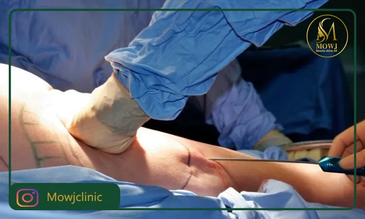 بهترین دکتر لیپوساکشن در تهران